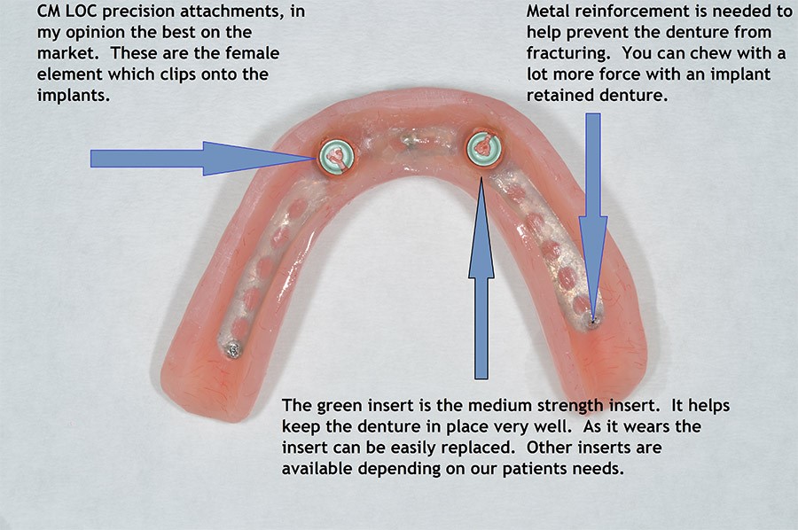 Relining Dentures Bowmansdale PA 17008